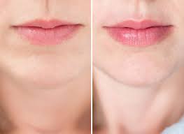 Before And After Using The Pmd Kiss Lip Plumping System Lip Plumper Lip Plumper Device Lip Fillers