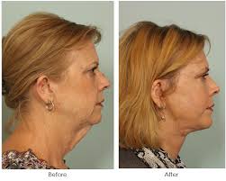 A little length with some layers cut in can soften your features and take the emphasis off any drooping jowels. El Paso Neck Lift Reduce Turkey Neck Jowls El Paso Cosmetic Surgery