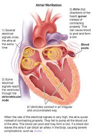 Image result for Atrial Fibrillation