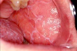 Image result for lichen planus on tongue)