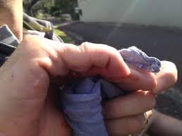 Image result for Lateral PIP Dislocation