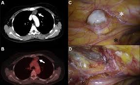 Ovarian cancer is a malignancy arising from the ovary. Thymic Metastasis Of Ovarian Cancer 33 Years After Primary Surgery The Annals Of Thoracic Surgery