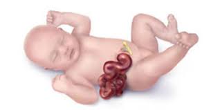.of the biofire filmarray gastrointestinal panel for etiologic diagnosis of infectious gastroenteritis. Facts About Gastroschisis Cdc