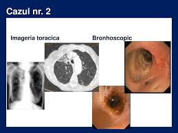 Incidenta maxima a bolii se inregistreaza la persoanele trecute de 40 de ani. Ppt Bronsita Acuta Powerpoint Presentation Free Download Id 3784160