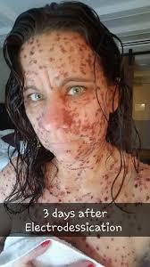 I'm itching all over with Angela pox