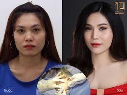 Anh thanh niên là nhân vật được tác giả dành cho nhiều ưu ái, miêu tả sâu sắc, để lại nhiều ấn tượng đẹp, về ngoại hình, anh có tầm vóc bé nhỏ, nét mặt rạng rỡ. Giáº£i Phap Khong Dao Keo Biáº¿n Ä'á»•i Máº·t Vuong Chá»¯ Ä'iá»n Thanh V Line Ngoi Sao