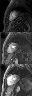 The possible pathophysiology and proposed guideline. Standardized Cardiovascular Magnetic Resonance Imaging Cmr Protocols 2020 Update Journal Of Cardiovascular Magnetic Resonance Full Text