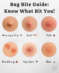 Image result for mosquito bite