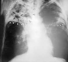 Tuberculose Wikipedia A Enciclopedia Livre