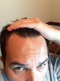 Electrolysis uses heat energy to destroy the individual hairs of your peak, which helps to prevent new hair growth. The Hair Loss Treatment That Reversed My Receding Hairline