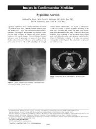 Image result for Cardiovascular Syphilis
