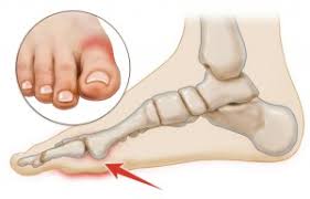 It may be difficult to walk because of the pain, especially if the big toe is fractured. Turf Toe Best Podiatrist Los Angeles University Foot And Ankle Institute