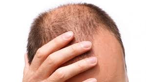 Alopecia areata, another type of hair loss, which causes bald patches on the scalp, is very prevalent in people at the age of 15 to 29. Coping With Hair Loss At An Early Age The Maitland Clinic