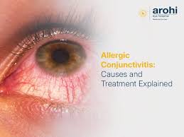 Image result for Allergic Conjunctivitis