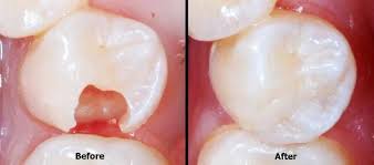 Toothpaste that gives you a healthy smile, with specialized solutions tailored to you. Dental Fillings Enamel Republic Dentist Kitchener