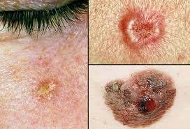 A dermatologist can perform a thorough screening of your skin, but between appointments, you need to monitor your skin for signs of skin cancer. Picture Of Skin Cancer Picture Image On Rxlist Com