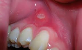 Image result for gum cancer symptoms