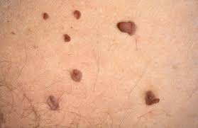 The skin is made up of three layers, including the epidermis, which is the top layer of the skin. Skin Tags Symptoms Treatments And Causes Healthdirect