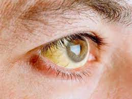 Ojos Amarillentos O Ictericia Que Lo Causa Y Como Se Trata