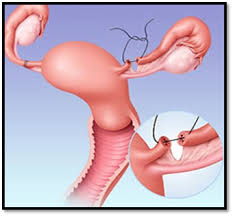 Check spelling or type a new query. Laparoscopic Tubal Recanalization Reversal Of Tubal Sterilization
