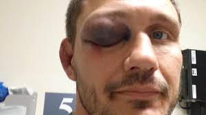 They seem to have really strange crumpled, lumpy or otherwise misshapen at first, i thought they were some kind of ear defects, but i quickly realized that they were something that there was something about those ears. Ufc News Worst Injuries To Happen During A Ufc Fight Givemesport