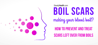 Maybe you would like to learn more about one of these? Boil Scars Making Your Blood Boil How To Prevent And Treat Scars Left Over From Boils Skin Hair Problems Articles Body Health Conditions Center Steadyhealth Com