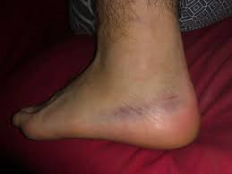 Die erkrankung die menisken sind zwei halbmondförmige, elastische gebilde aus knorpel, die innen und außen. Umgeknickt Zum Arzt Gesundheit Und Medizin Beine