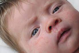 5 Most Common Baby Skin Allergy Symptoms And Its Causes Baby Food Allergies Skin Allergy Symptoms Food Allergies