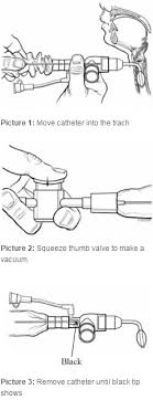 tracheostomy care suctioning with a closed suction system