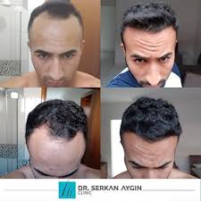 Sacekimi Sacekimiuzmani Sacekimmerkezi Sacekimioncesi Sacekimisonrasi Drserkanaygin Hairt Hair Transplant Best Hair Transplant Fue Hair Transplant