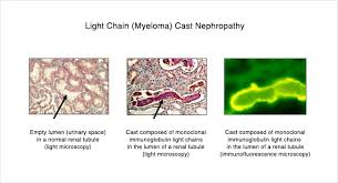 Light Chain Deposition Disease Unc Kidney Center
