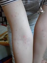 La dermatite neglect è una malattia della pelle che si verifica quando un individuo non si pulisce sufficientemente. Buono Senza Sale Dermatite