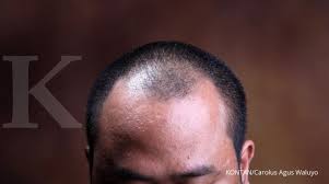 Kerontokan ini terjadi secara menyeluruh pada bagian kepala sehingga tidak menyebabkan kebotakan pada satu area saja (pitak). 3 Cara Mudah Mengatasi Rambut Rontok Dan Tips Mencegahnya