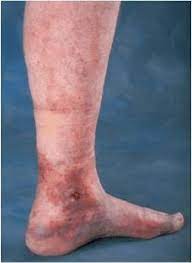 The practice of wound care, which encompasses the management of chronic and acute wounds, has expanded significantly over the past two decades due to an increasing geriatric population. Foot And Leg Wound Care Treatment In Port St Lucie Fl Treasure Coast Heart And Vascular