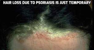 Having psoriasis is stressful and hair fall associated with psoriasis make it worse. Scalp Psoriasis And Hair Loss Psoriasis Self Management Psoriasis Hair Scalp Psoriasis Psoriasis Hair Loss