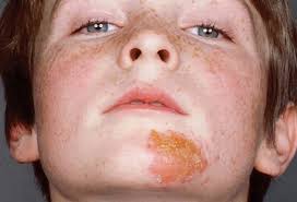 Image result for shingles in children