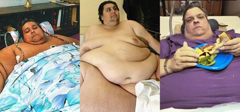 The Medical Journeys of the Most Obese Humans in History: Treatments ...