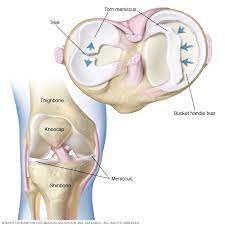 The meniscus sits between the cartilage surfaces of the bone to distribute weight and to improve the stability of the joint. Torn Meniscus Symptoms And Causes Mayo Clinic