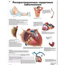 Common Cardiac Disorders Chart