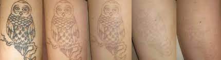 Oregon aesthetics provides a wide variety of hair removal options, such as laser treatments and waxing. Tattoo Removal Vida Aesthetic Medicine Salem Oregon