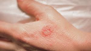 Image result for Eczema nummulare