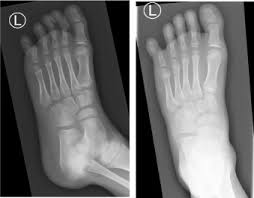Image result for Interphalangeal Dislocation