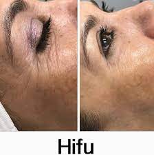 Hifu Face Tightening Before And After Beauty Procedures Face Tightening Facelift