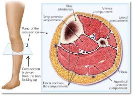 Image result for Compartment Syndrome