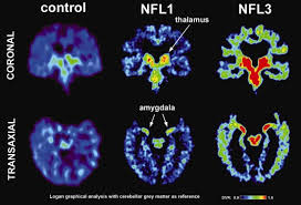 The size differences were directly correlated with symptom severity, with the most. New Study Finds Brain Damage In Living Ex Nfl Players League Of Denial The Nfl S Concussion Crisis Frontline Pbs Official Site