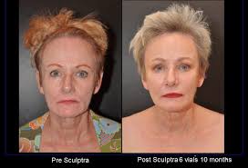 It doesn't take long to draw people or anything for that matter but to get good at it , takes practise. Learn The Sculptra Secret From Baltimore S Dr Dean Kane