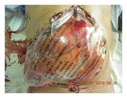 Borraez gaona, md, of bogota, colombia, was the application of a plastic bag over the open abdomen in injured patients. Bogota Technique Using A Presterilized Soft 3 L Iv Bag Download Scientific Diagram