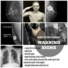 Breast lumps, bumps or breast soreness may not be just because of a hard workout in the gym or other heavy lifting, etc. Breast Cancer In Men Abc Advocates For Breast Cancer South Africa