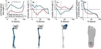 Image result for Foot Progression Angle