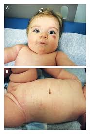 Image result for Urticaria pigmentosa children